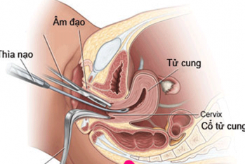 Nong gắp thai có đau không? Địa chỉ phá thai uy tín TPHCM