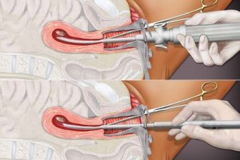 Thai lớn có phá được không? Phá thai lớn bằng phương pháp nào an toàn?